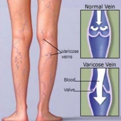 Vein Gel with Horse Chestnut Extract and Eucalyptus Oil, 100 ml / 3,38 Oz