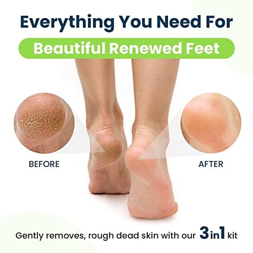 EXTRA STRENGTH Callus Remover Gel For Feet - Made In USA, Professional Foot Scrubber To Remove Calluses and Dead Skin on Heel, Exfoliator and Softener, Pedicure Supplies Fix Dry Cracked Peeling Heels (2 Pack)