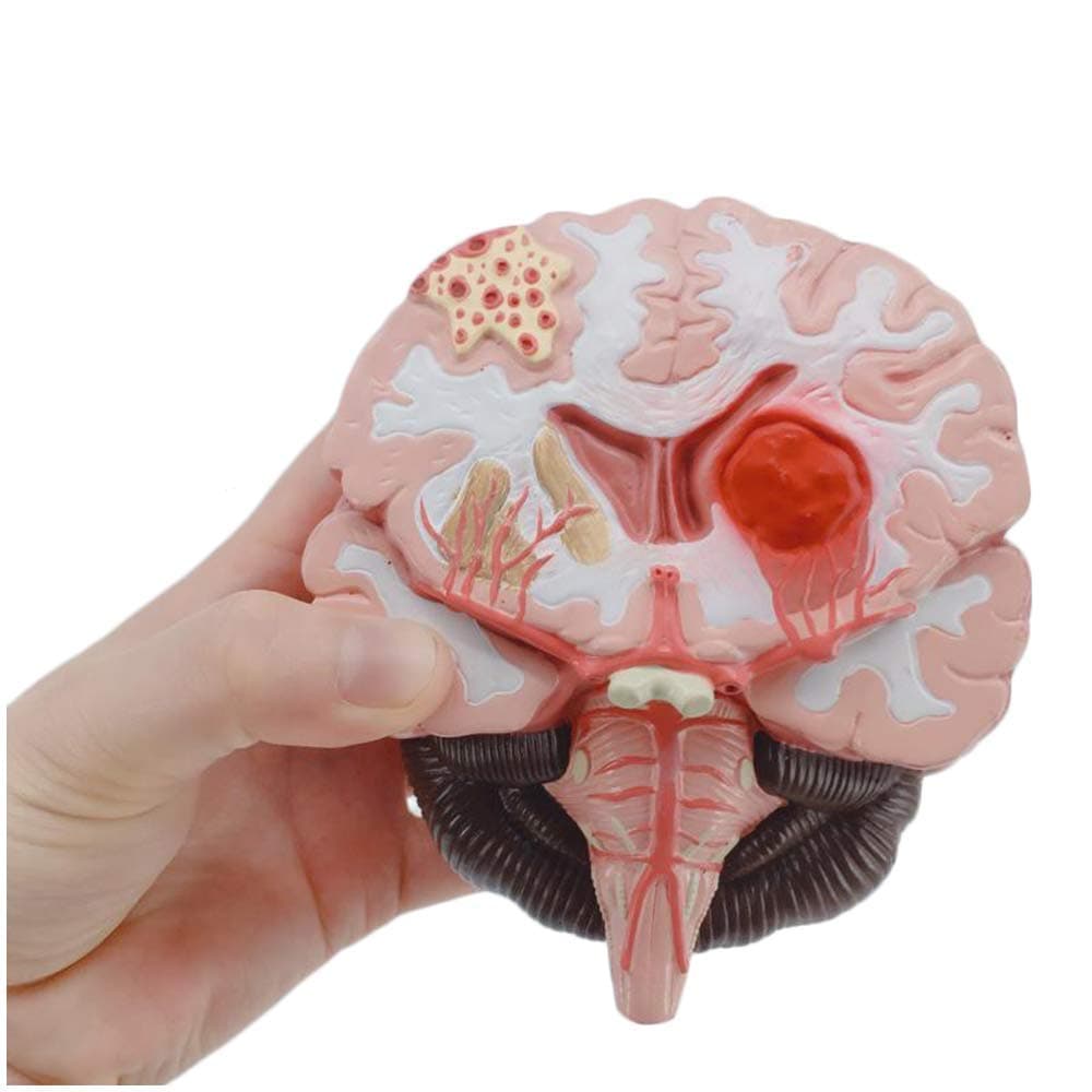 Educational Model Anatomical Brain Model Malformed Brain Pathological Structure Model Cerebral Cortex Gray Matter Brain Stem Hemorrhage Arteriovenous Anatomy Model,Medical Models