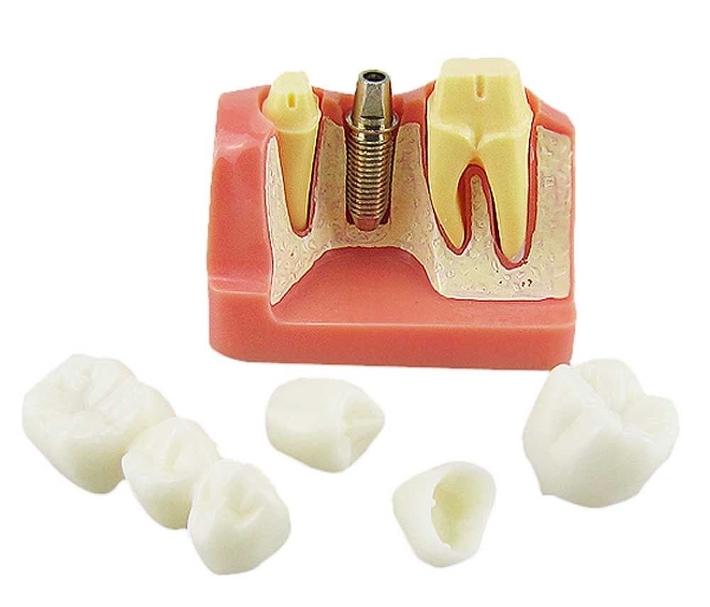 Dental Implant Study Analysis Crown Bridge Demonstration Teeth Model