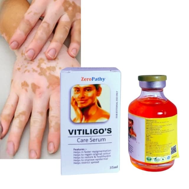 Zero Pathy Vaitiligos Gel White Spot Clear Vaitiligos cream Safed Daag -