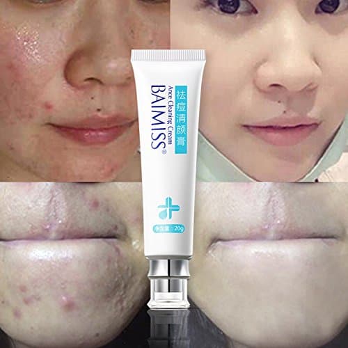 BAIMISS Acne Cleaning Cream Skin Care Face Acne Cream Remover 20gm