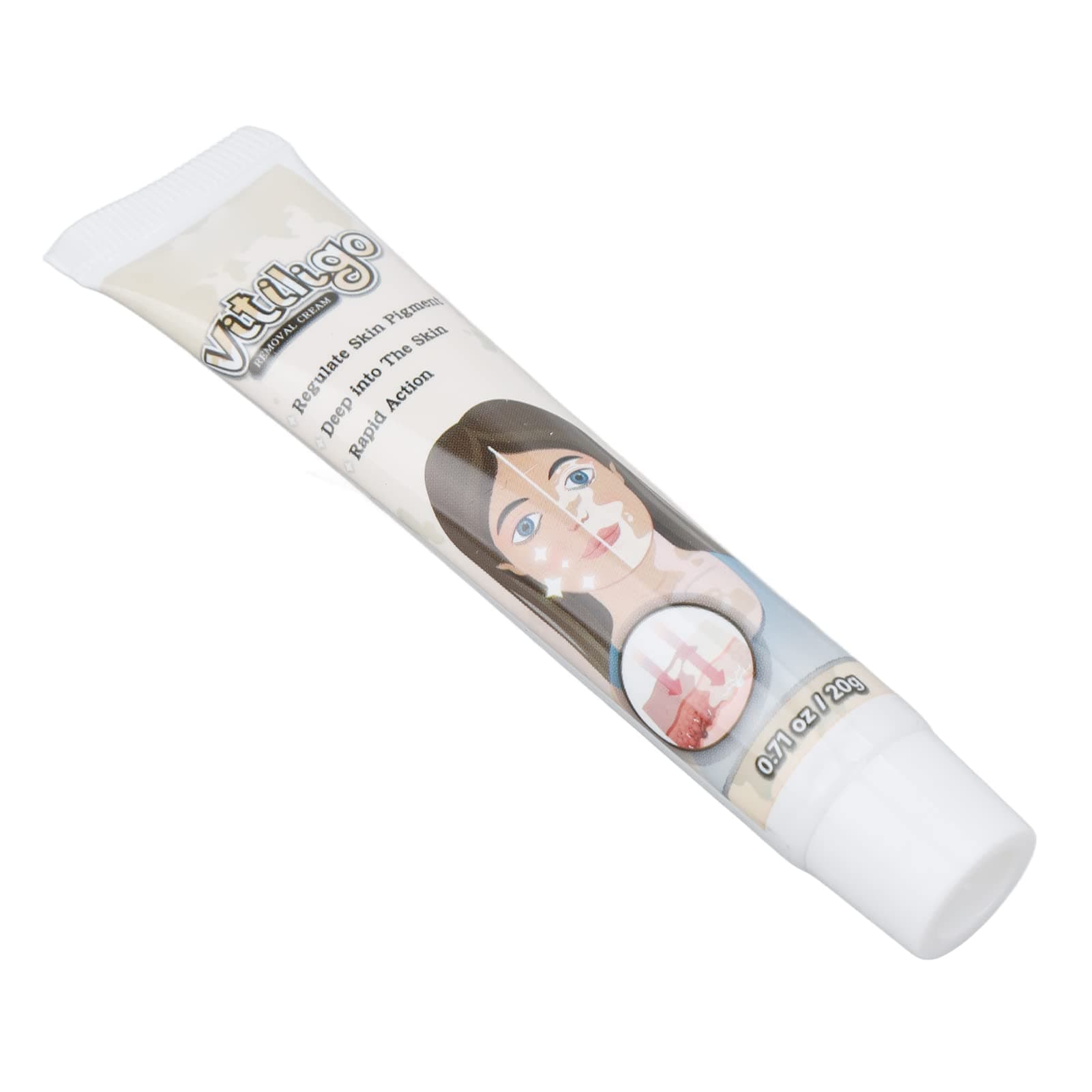 White Spots Vitiligo Cream, Herbal Extract Portable Vitiligo Cream Mild for Health Care for Skin Pigmentation