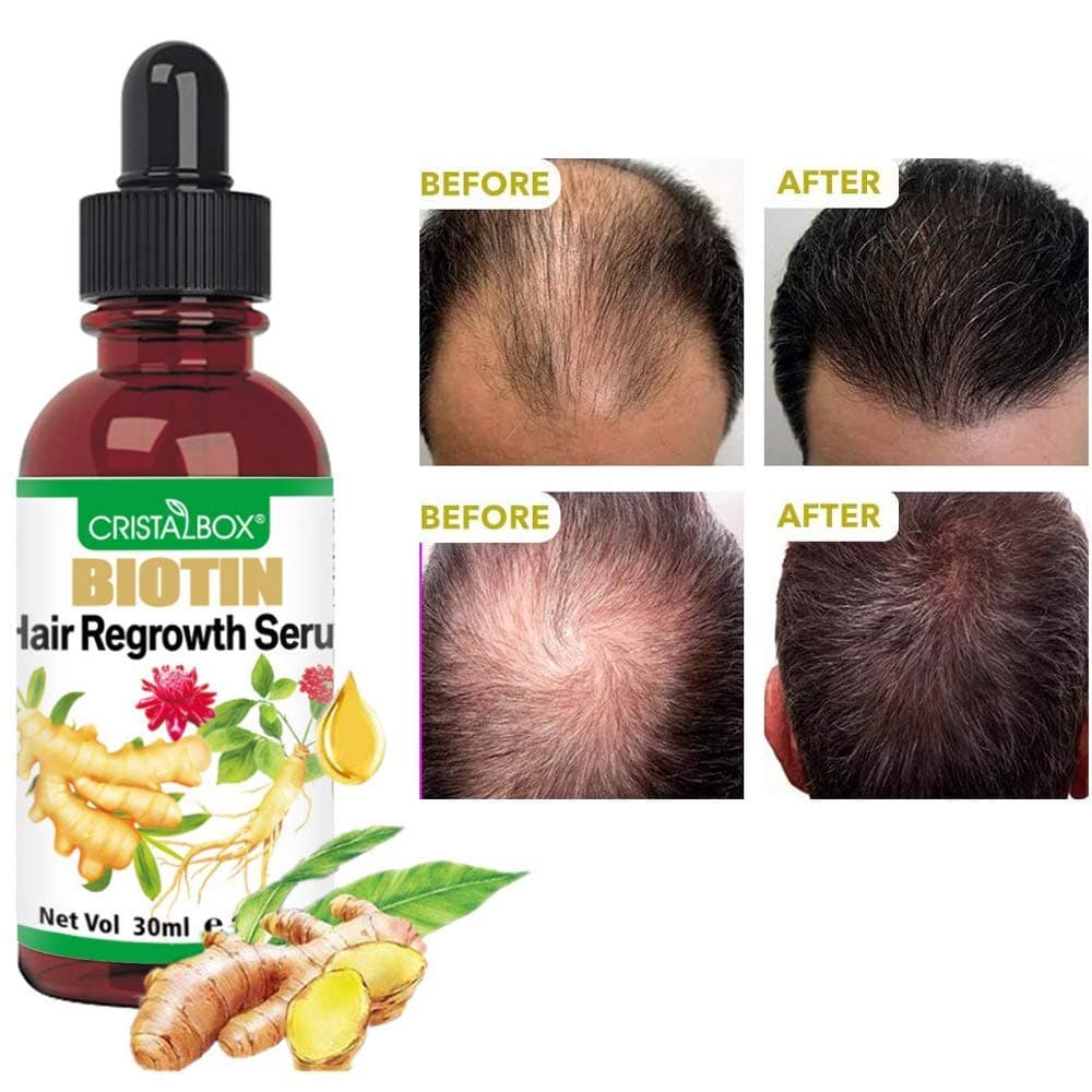 5 PACK Ginger Oil for Hair Growth,Hair Growth Serum,2022 Biotin Hair Growth Oil,Hair Growth Ginger Serum for Men and Women,Hair Growth Treatment,Hair Loss Treatment,Promotes Thicker,Growth Hair
