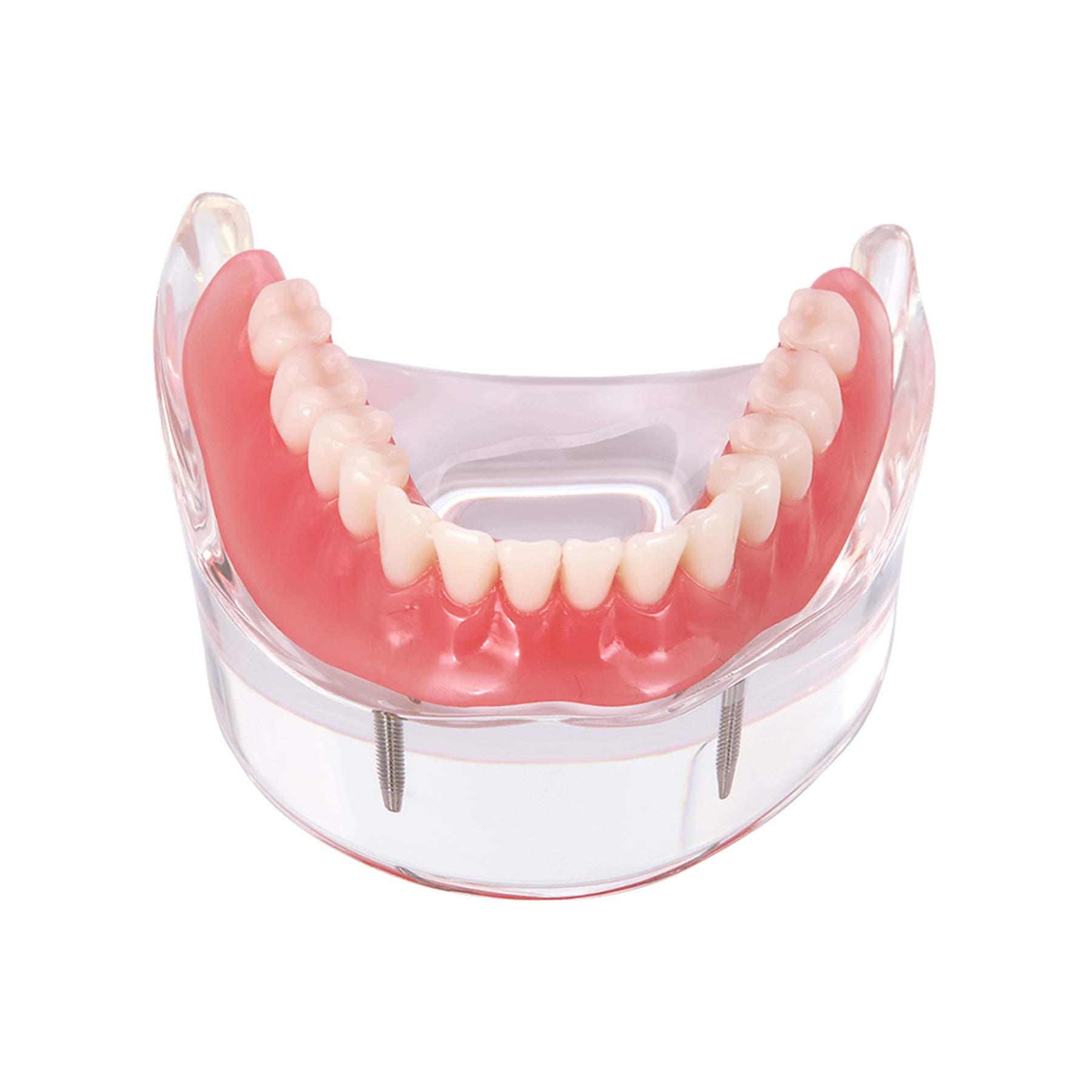 Dental Teaching Model Overdenture Inferior with 2 Implants Demo #6002