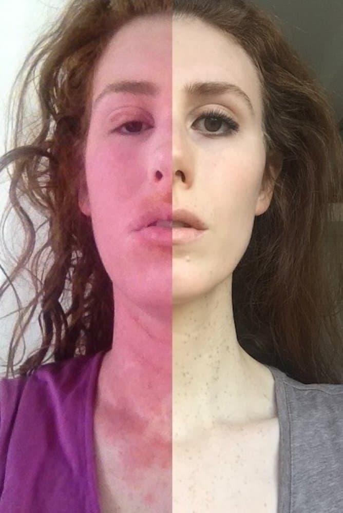 Curing my Incurable Eczema: My Topical Steroid Withdrawal (TSW) Journey