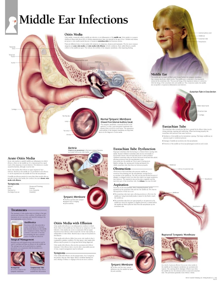 Middle Ear Infection chart: Laminated Wall Chart
